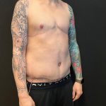 Body Lift Before & After Patient #8098