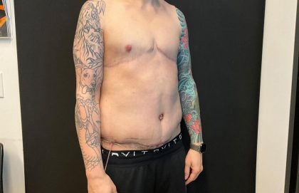 Body Lift Before & After Patient #8098