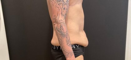Body Lift Before & After Patient #8098