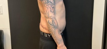 Body Lift Before & After Patient #8098