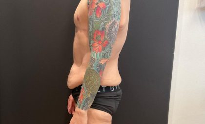 Body Lift Before & After Patient #8098