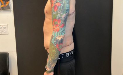 Body Lift Before & After Patient #8098