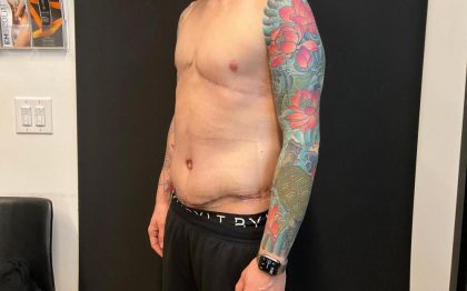 Body Lift Before & After Patient #8098