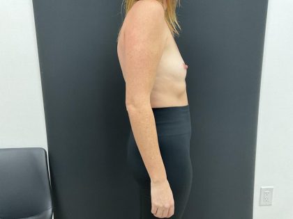 Breast Augmentation Before & After Patient #8044