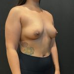 Breast Augmentation Before & After Patient #8045