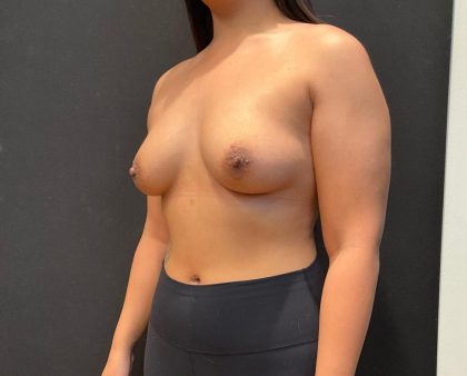 Breast Augmentation Before & After Patient #8045