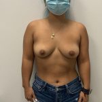 Breast Augmentation Before & After Patient #8049