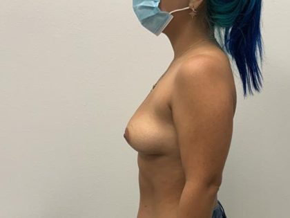 Breast Augmentation Before & After Patient #8049