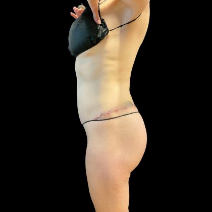 Butt Lift Before & After Patient #8109