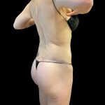 Butt Lift Before & After Patient #8109