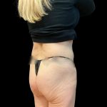 Butt Lift Before & After Patient #8109