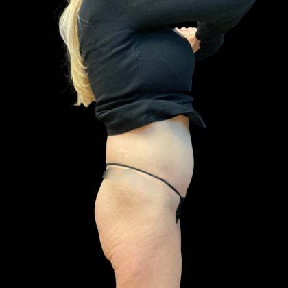Butt Lift Before & After Patient #8109