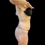 Butt Lift Before & After Patient #8109