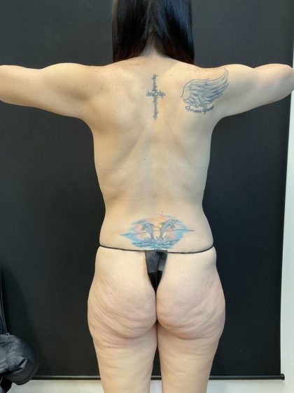 Butt Lift Before & After Patient #8123