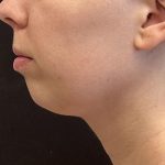 Chin Augmentation Before & After Patient #8147