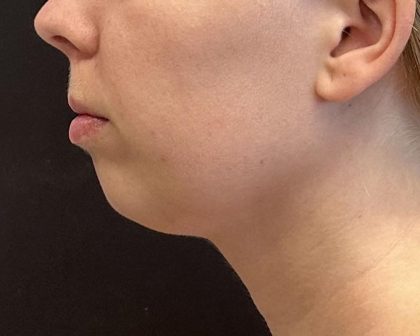 Chin Augmentation Before & After Patient #8147