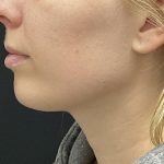 Chin Augmentation Before & After Patient #8147