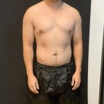 High Definition Liposuction Before & After Patient #8184