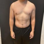 High Definition Liposuction Before & After Patient #8184