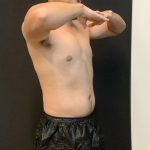 High Definition Liposuction Before & After Patient #8184