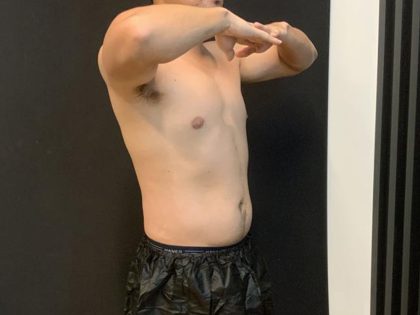High Definition Liposuction Before & After Patient #8184