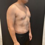 High Definition Liposuction Before & After Patient #8184