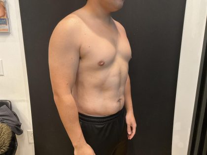 High Definition Liposuction Before & After Patient #8184