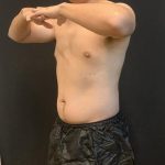 High Definition Liposuction Before & After Patient #8184