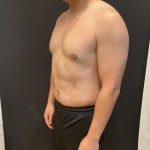 High Definition Liposuction Before & After Patient #8184