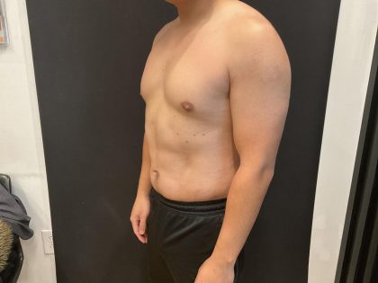High Definition Liposuction Before & After Patient #8184