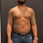 High Definition Liposuction Before & After Patient #8185
