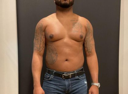 High Definition Liposuction Before & After Patient #8185