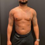 High Definition Liposuction Before & After Patient #8185