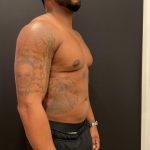High Definition Liposuction Before & After Patient #8185