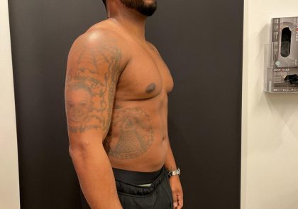 High Definition Liposuction Before & After Patient #8185