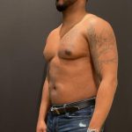 High Definition Liposuction Before & After Patient #8185