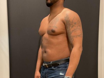 High Definition Liposuction Before & After Patient #8185