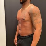 High Definition Liposuction Before & After Patient #8185