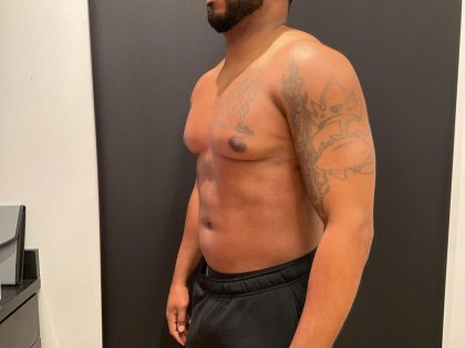 High Definition Liposuction Before & After Patient #8185