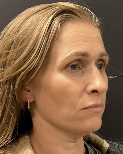 Hyper Dilute Radiesse Before & After Patient #8145