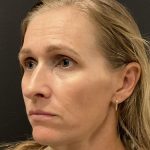 Hyper Dilute Radiesse Before & After Patient #8145