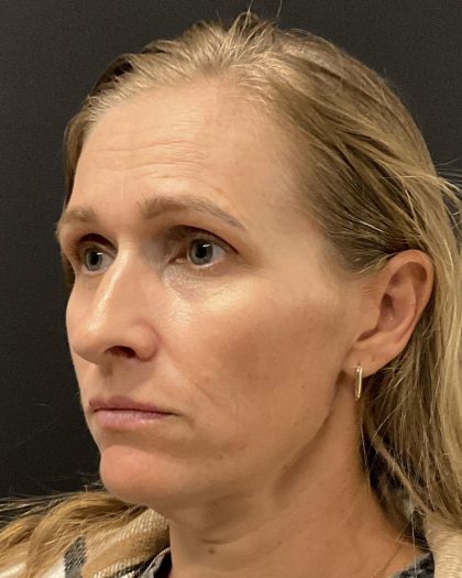 Hyper Dilute Radiesse Before & After Patient #8145