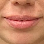 Lip Filler Before & After Patient #8079