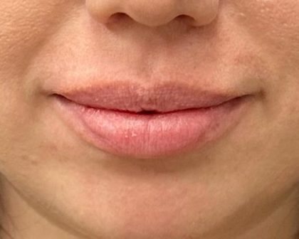 Lip Filler Before & After Patient #8079