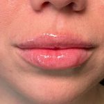 Lip Filler Before & After Patient #8079