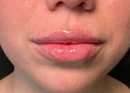 Lip Filler Before & After Patient #8079
