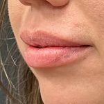 Lip Filler Before & After Patient #8079