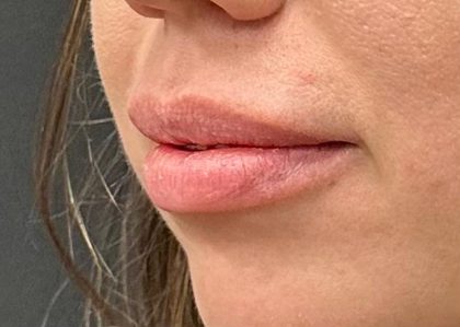 Lip Filler Before & After Patient #8079