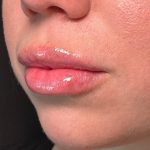 Lip Filler Before & After Patient #8079