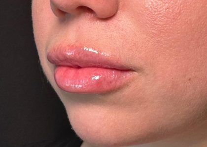 Lip Filler Before & After Patient #8079